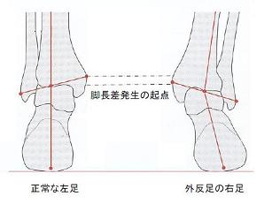 脚長差の起点