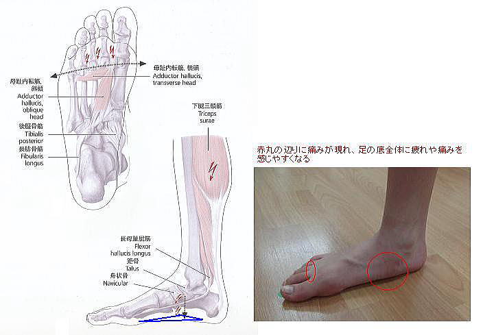 flatfoot1-1